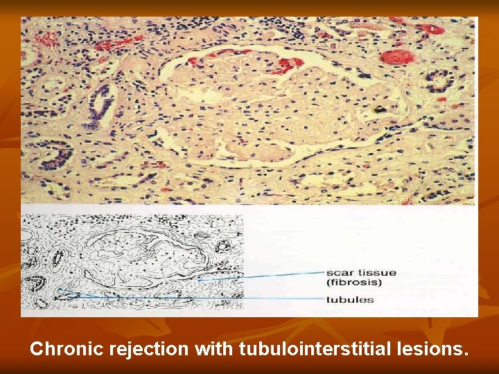 Chronic rejection with tubulointerstitial lesions. Chronic rejection with tubulointerstitial lesions.