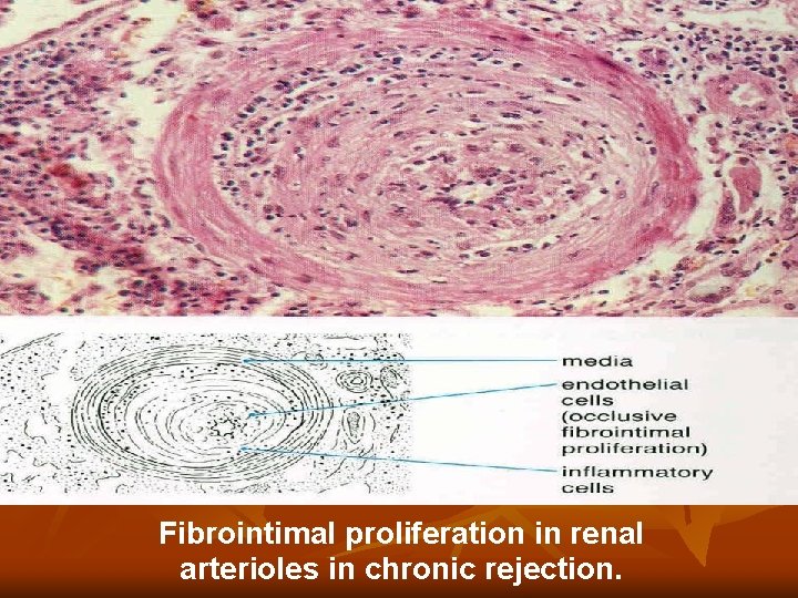 Fibrointimal proliferation in renal arterioles in chronic rejection. Fibrointimal proliferation in renal arterioles in chronic rejection.
