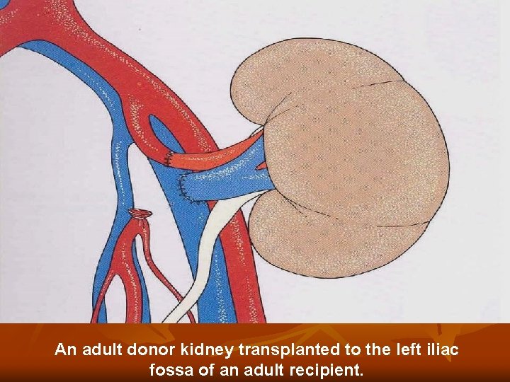 An adult donor kidney transplanted to the left iliac fossa of an adult recipient. An adult donor kidney transplanted to the left iliac fossa of an adult recipient.