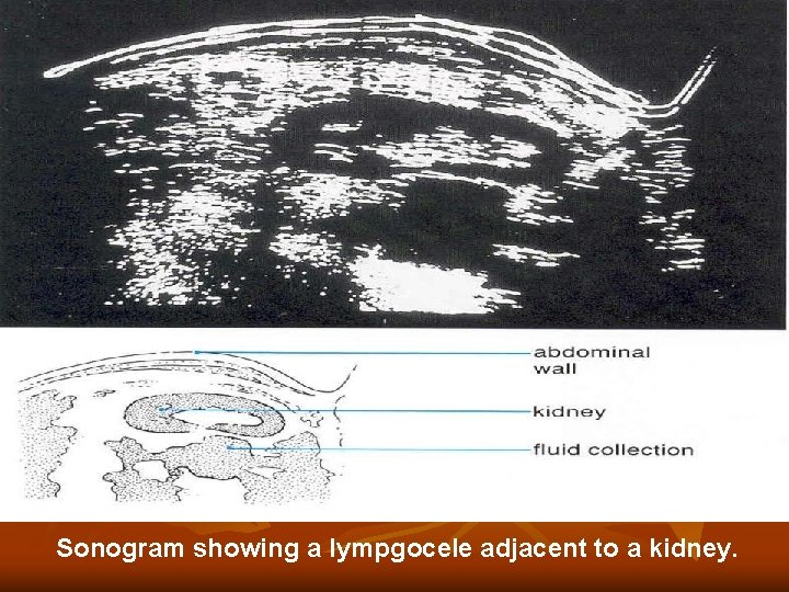 Sonogram showing a lympgocele adjacent to a kidney. Sonogram showing a lympgocele adjacent to a kidney.