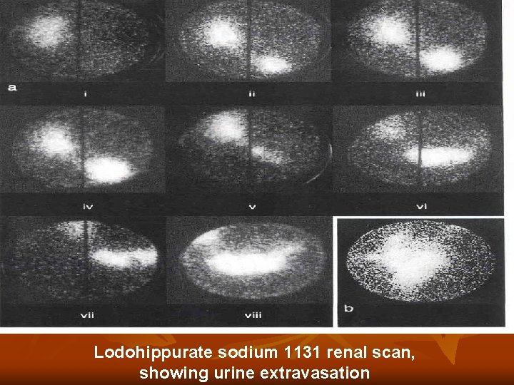 Lodohippurate sodium 1131 renal scan, showing urine extravasation Lodohippurate sodium 1131 renal scan, showing urine extravasation