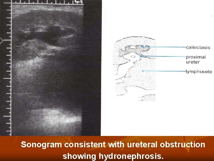Sonogram consistent with ureteral obstruction showing hydronephrosis. Sonogram consistent with ureteral obstruction showing hydronephrosis.