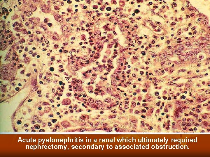 Acute pyelonephritis in a renal which ultimately required nephrectomy, secondary to associated obstruction. Acute pyelonephritis in a renal which ultimately required nephrectomy, secondary to associated obstruction.