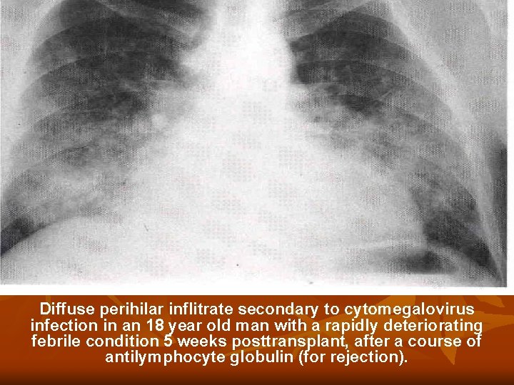 Diffuse perihilar inflitrate secondary to cytomegalovirus infection in an 18 year old man with Diffuse perihilar inflitrate secondary to cytomegalovirus infection in an 18 year old man with