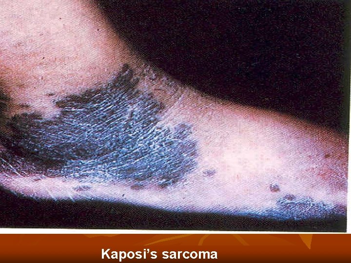 Kaposi’s sarcoma Kaposi’s sarcoma