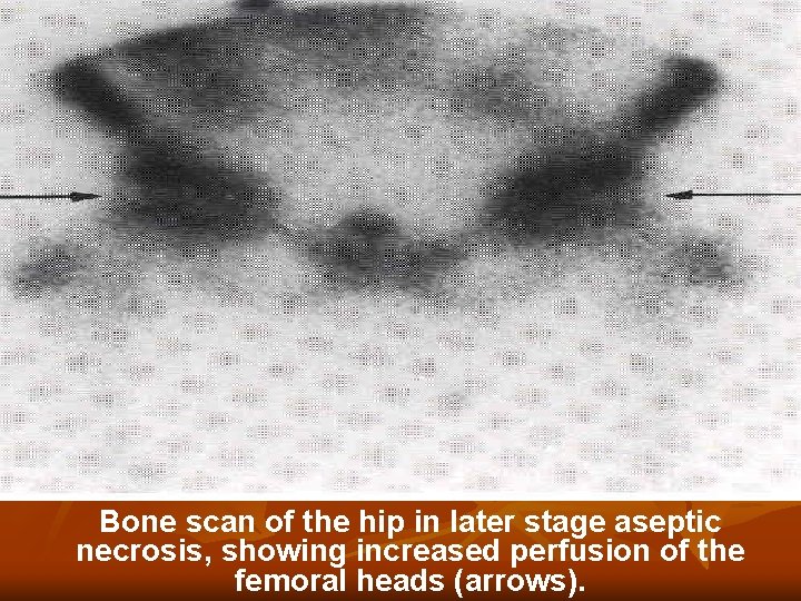 Bone scan of the hip in later stage aseptic necrosis, showing increased perfusion of Bone scan of the hip in later stage aseptic necrosis, showing increased perfusion of
