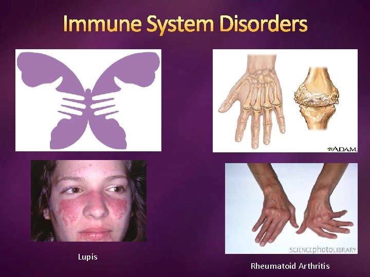 Immune System Disorders Lupis Rheumatoid Arthritis 