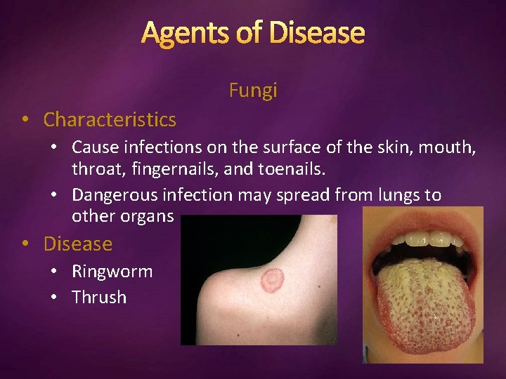 Agents of Disease Fungi • Characteristics • Cause infections on the surface of the