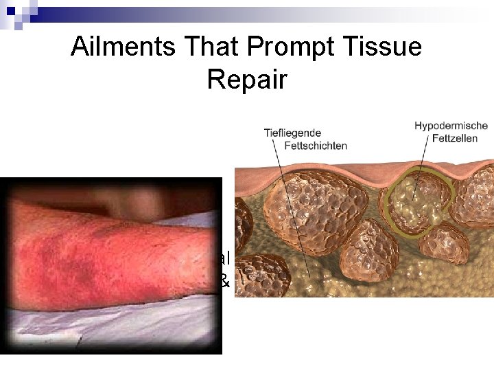 Ailments That Prompt Tissue Repair n Cellulitis: A bacterial infection of the skin &