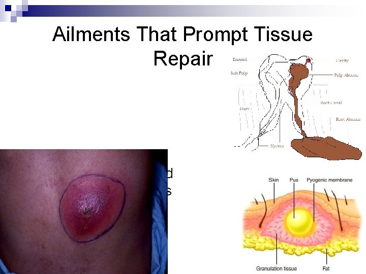 Ailments That Prompt Tissue Repair n Abscesses: Inflamed infection of tissues as a result