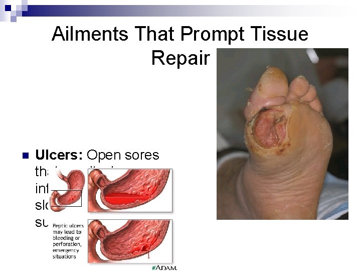 Ailments That Prompt Tissue Repair n Ulcers: Open sores that result when inflamed tissue