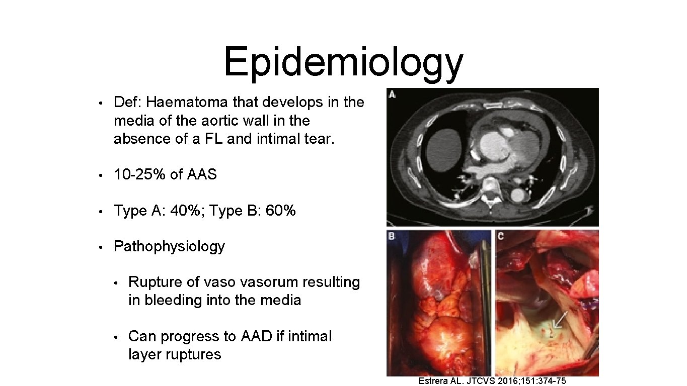 Epidemiology • Def: Haematoma that develops in the media of the aortic wall in