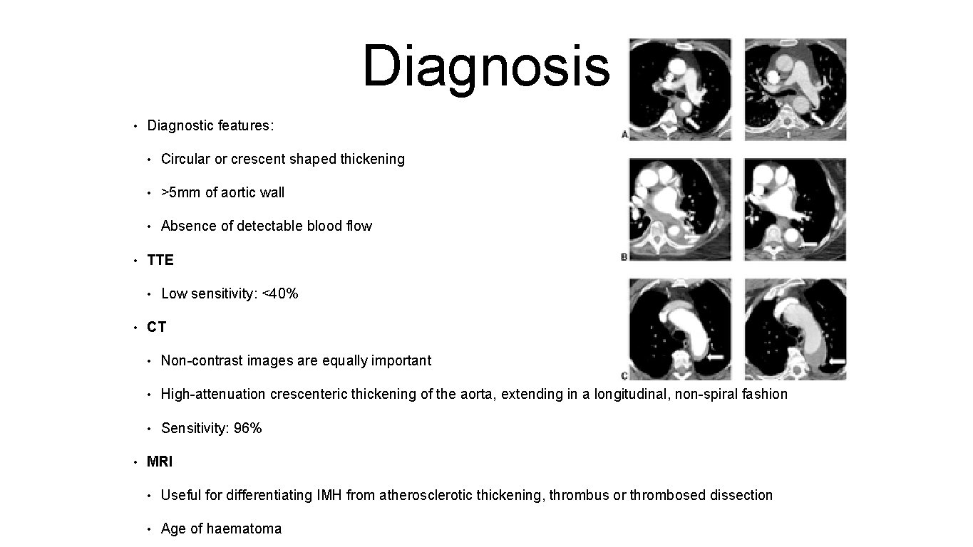 Diagnosis • • Diagnostic features: • Circular or crescent shaped thickening • >5 mm