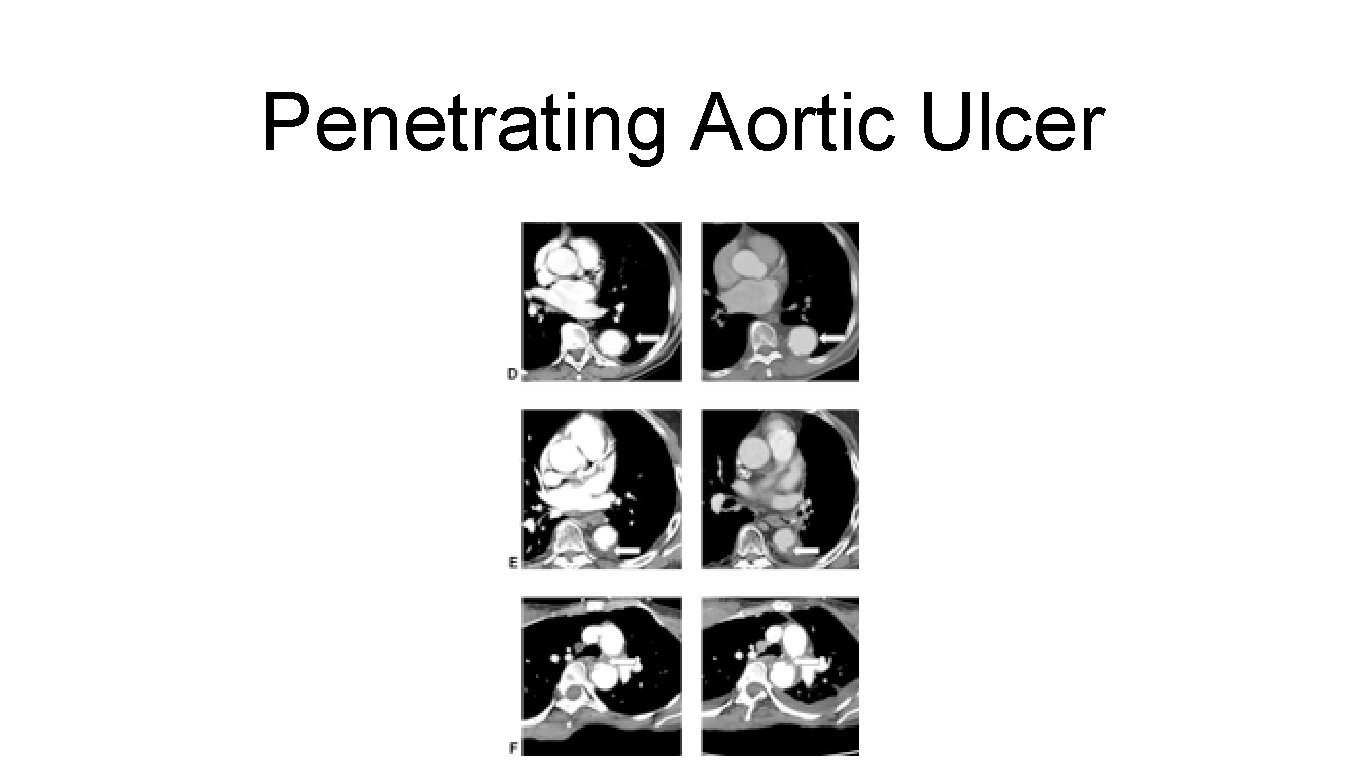 Penetrating Aortic Ulcer 