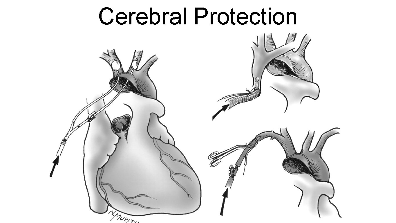 Cerebral Protection 