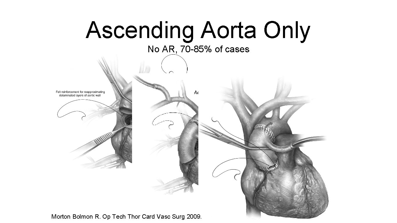 Ascending Aorta Only No AR, 70 -85% of cases Morton Bolmon R. Op Tech