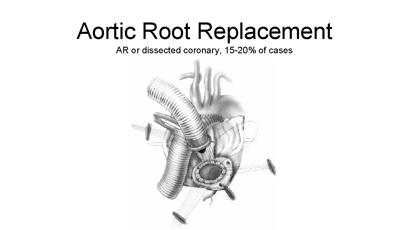 Aortic Root Replacement AR or dissected coronary, 15 -20% of cases 