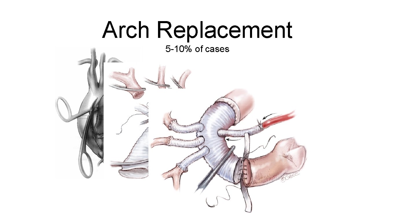 Arch Replacement 5 -10% of cases 