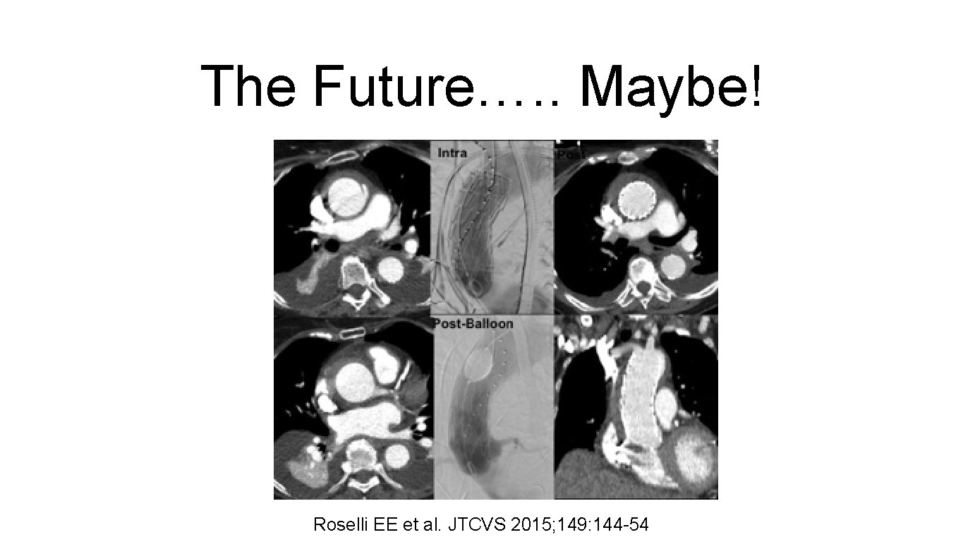 The Future…. . Maybe! Roselli EE et al. JTCVS 2015; 149: 144 -54 