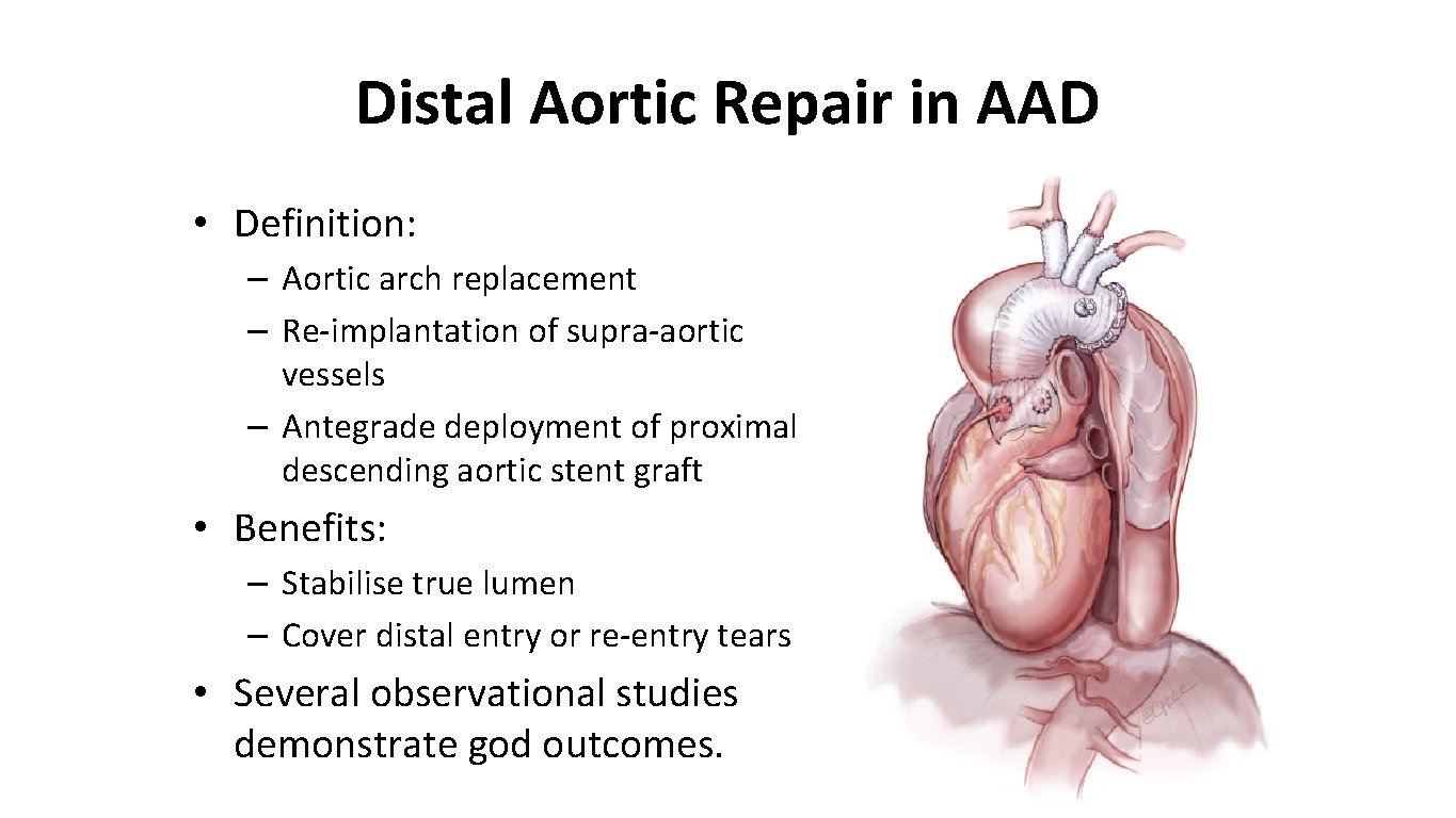 Distal Aortic Repair in AAD • Definition: – Aortic arch replacement – Re-implantation of