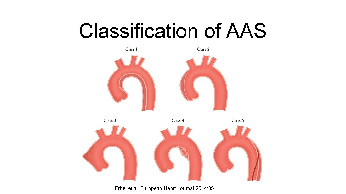 Classification of AAS Erbel et al. European Heart Journal 2014; 35. 