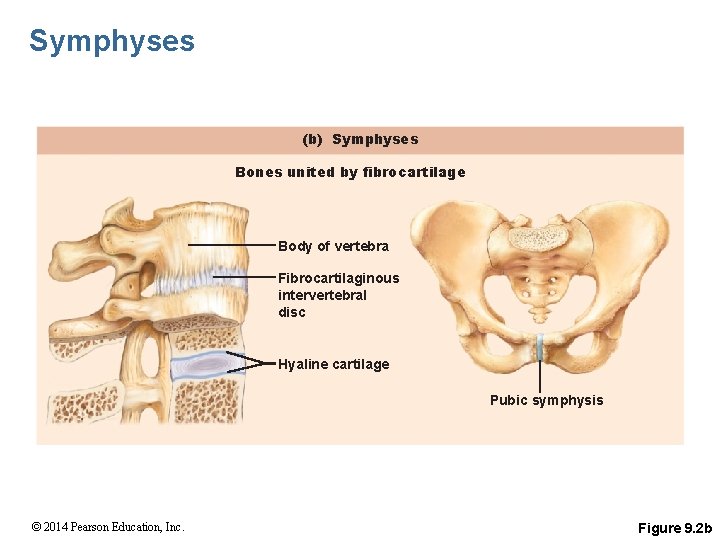 Symphyses (b) Symphyses Bones united by fibrocartilage Body of vertebra Fibrocartilaginous intervertebral disc Hyaline