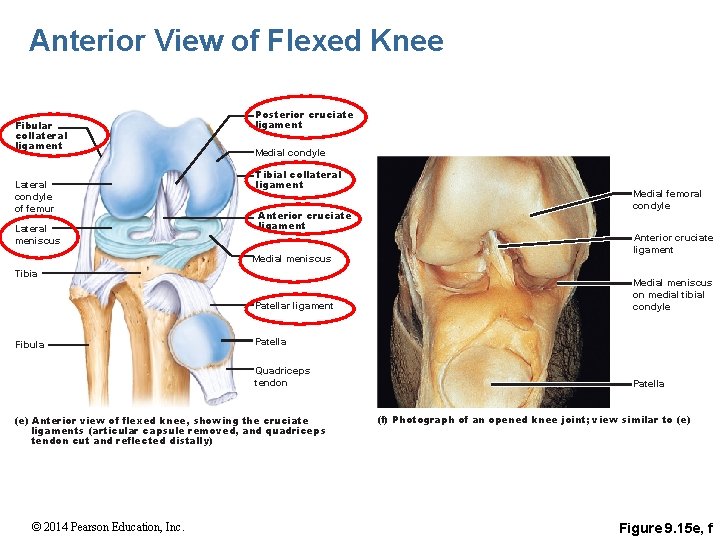 Anterior View of Flexed Knee Fibular collateral ligament Lateral condyle of femur Lateral meniscus