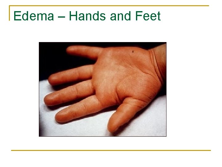 Edema – Hands and Feet 