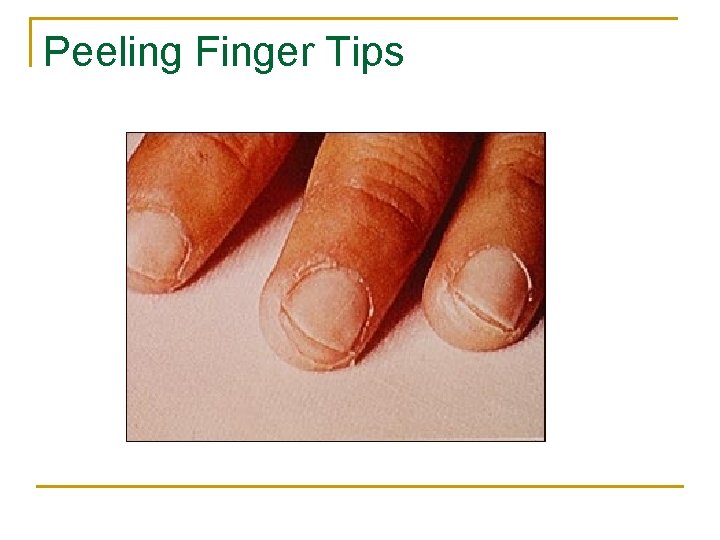 Peeling Finger Tips 