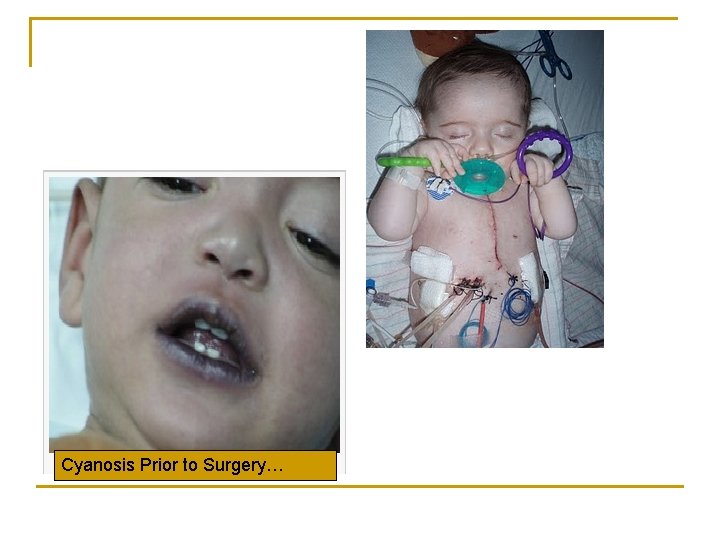 Cyanosis Prior to Surgery… 