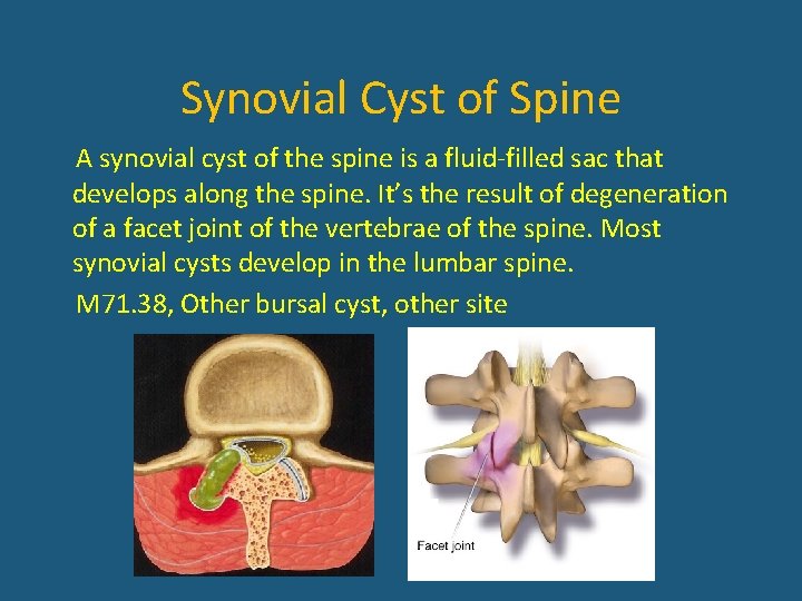 Synovial Cyst of Spine A synovial cyst of the spine is a fluid-filled sac