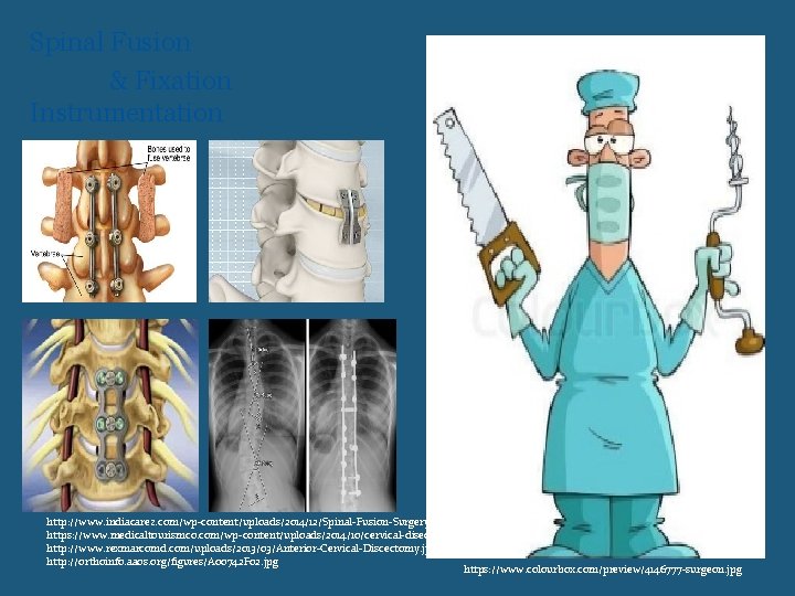 Spinal Fusion & Fixation Instrumentation http: //www. indiacarez. com/wp-content/uploads/2014/12/Spinal-Fusion-Surgery 1. jpg https: //www. medicaltourismco.