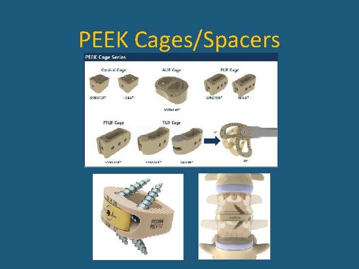 PEEK Cages/Spacers 