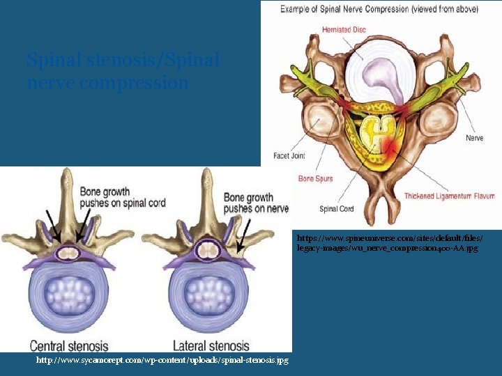Spinal stenosis/Spinal nerve compression https: //www. spineuniverse. com/sites/default/files/ legacy-images/wu_nerve_compression 400 -AA. jpg http: //www.