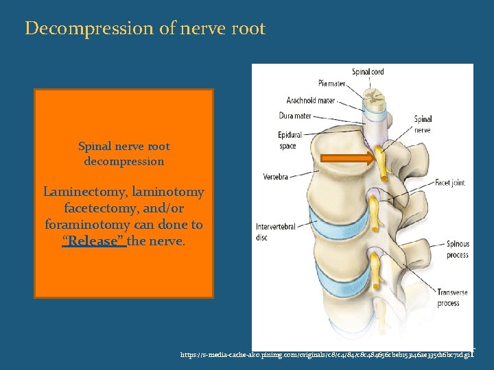 Decompression of nerve root Spinal nerve root decompression Laminectomy, laminotomy facetectomy, and/or foraminotomy can