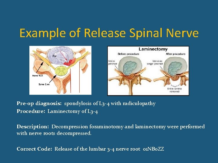Example of Release Spinal Nerve Pre-op diagnosis: spondylosis of L 3 -4 with radiculopathy