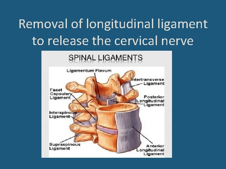 Removal of longitudinal ligament to release the cervical nerve 