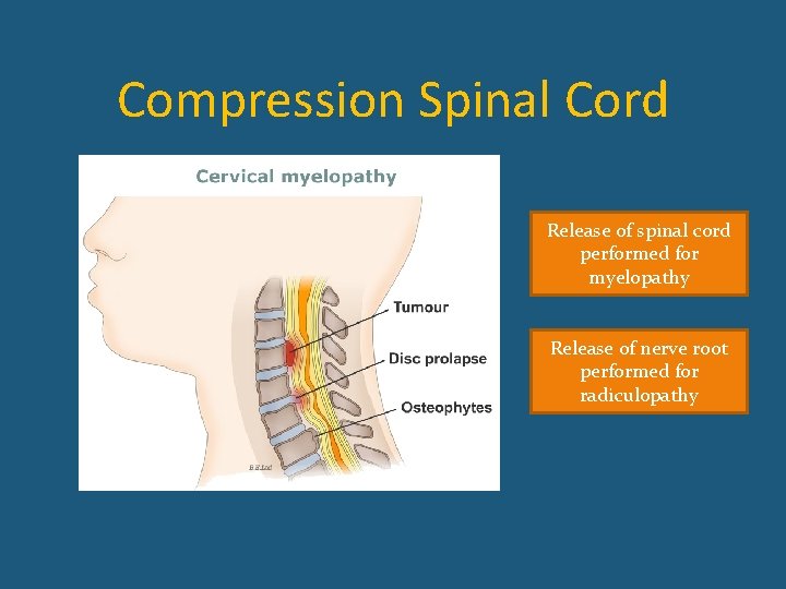 Compression Spinal Cord Release of spinal cord performed for myelopathy Release of nerve root