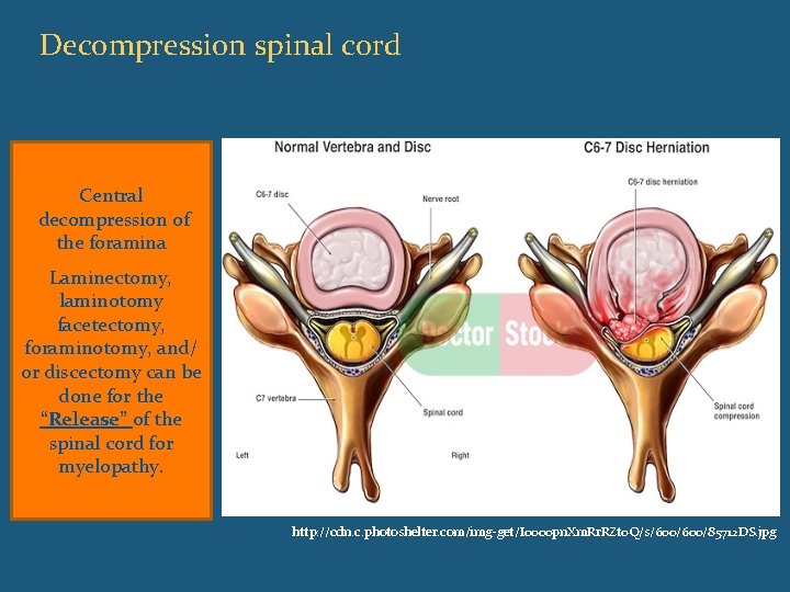 Decompression spinal cord Central decompression of the foramina Laminectomy, laminotomy facetectomy, foraminotomy, and/ or