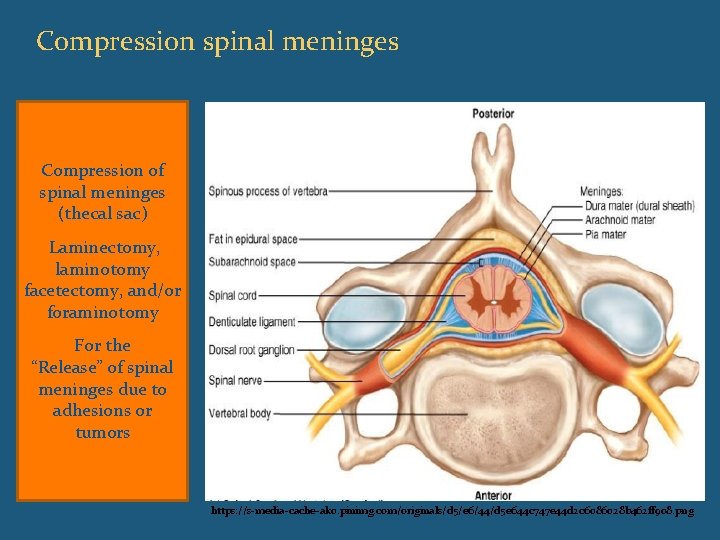 Compression spinal meninges Compression of spinal meninges (thecal sac) Laminectomy, laminotomy facetectomy, and/or foraminotomy