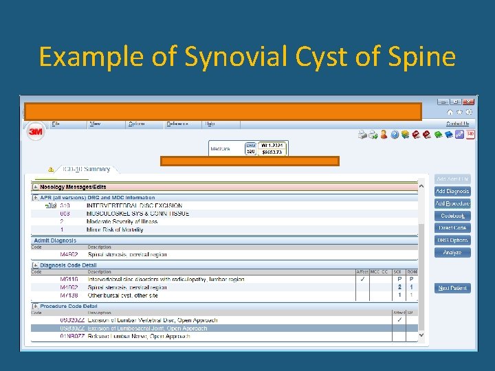 Example of Synovial Cyst of Spine 