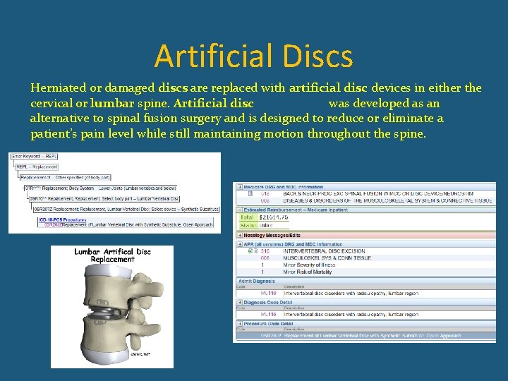 Artificial Discs Herniated or damaged discs are replaced with artificial disc devices in either