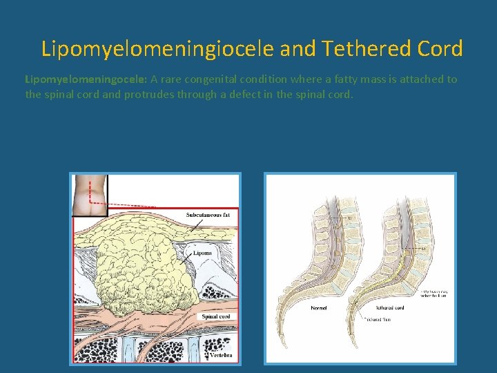 Lipomyelomeningiocele and Tethered Cord Lipomyelomeningocele: A rare congenital condition where a fatty mass is