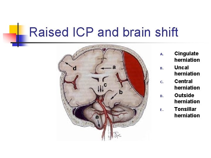 Raised ICP and brain shift A. B. C. D. E. Cingulate herniation Uncal herniation