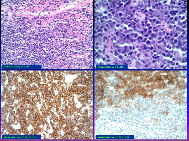 Mediastinal tissue, H-E, x 200 Mediastinal tissue, H-E, x 400 Mediastinal tissue, IHC, CD