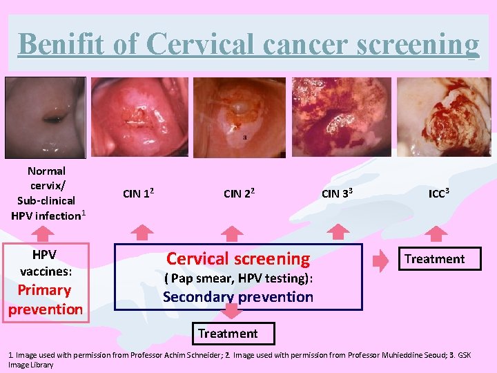 Benifit of Cervical cancer screening Normal cervix/ Sub-clinical HPV infection 1 HPV vaccines: Primary