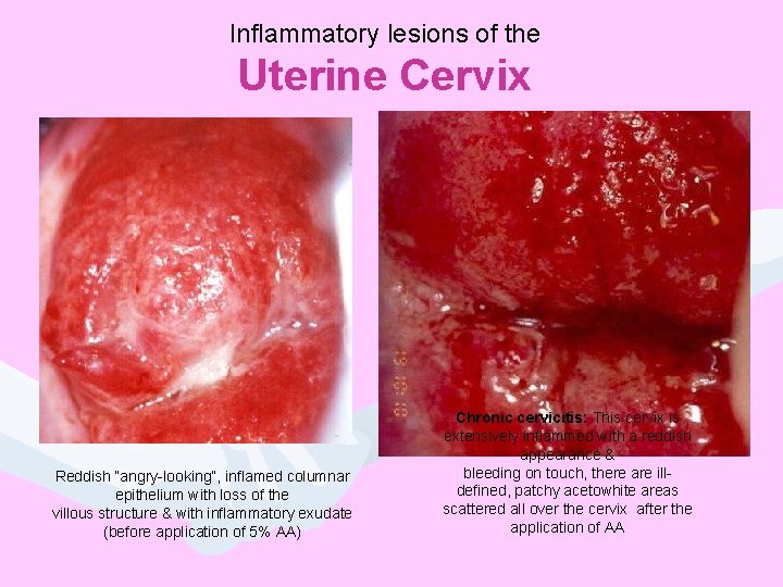 Inflammatory lesions of the Uterine Cervix Reddish “angry-looking”, inflamed columnar epithelium with loss of