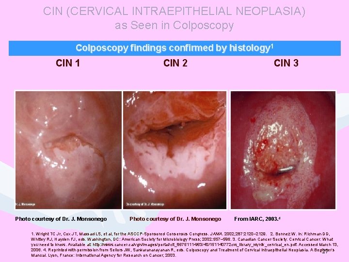 CIN (CERVICAL INTRAEPITHELIAL NEOPLASIA) as Seen in Colposcopy findings confirmed by histology 1 CIN