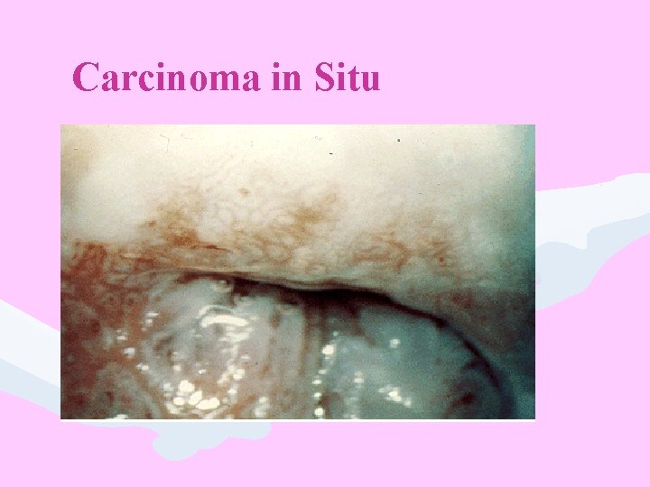 Carcinoma in Situ 