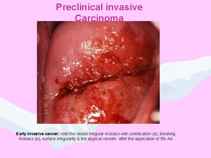 Preclinical invasive Carcinoma Early invasive cancer: note the raised irregular mosaics with umbilication (a),